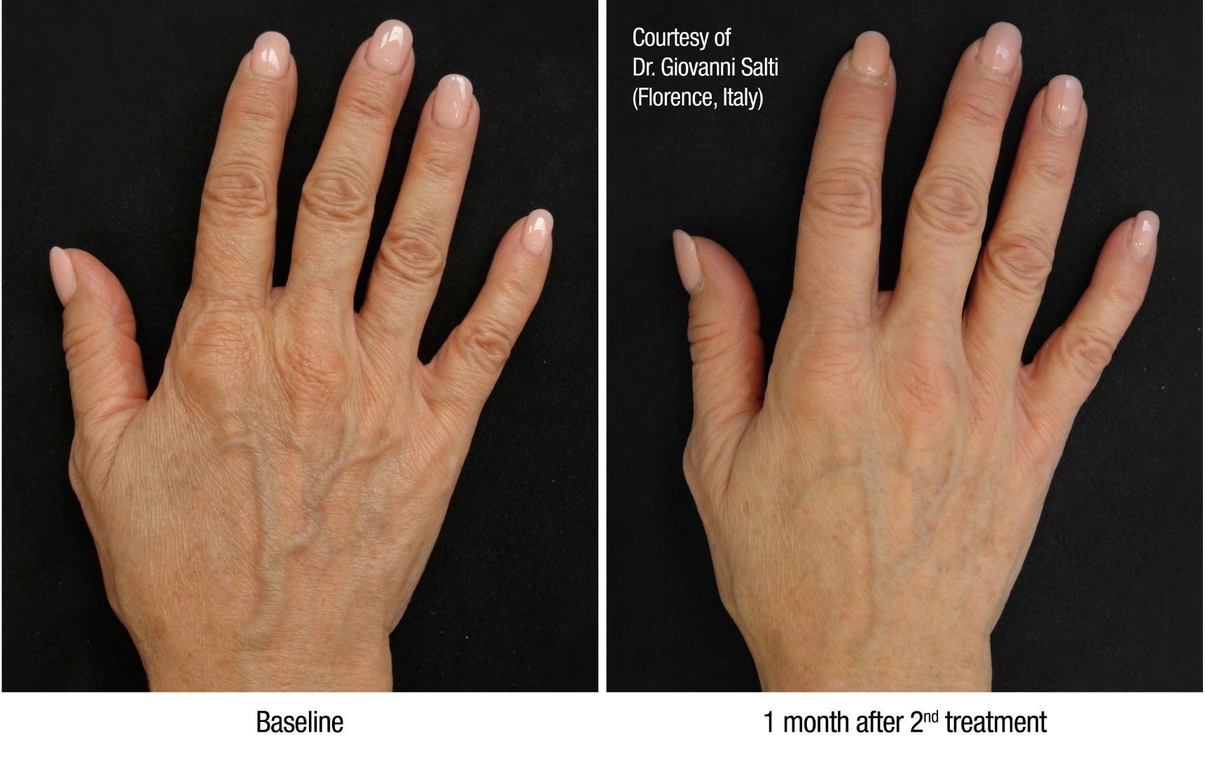 Before-After_HANDS2